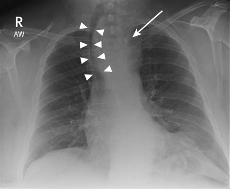 Abnormal Chest X Ray Esophagus