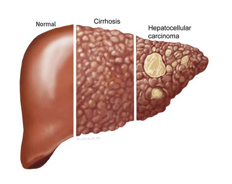 WORLD HEPATITIS DAY 2017: How Do We "ELIMINATE #Hepatitis"? The Strategic Framework- WHO | DR ...