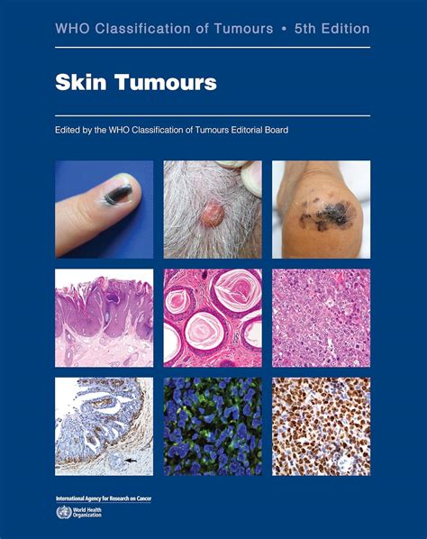 Skin Tumours: WHO Classification of Tumours: 9789283245353: Medicine ...