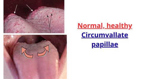 Multiple Bumps on the Back of Your Tongue? Most Likely Reasons