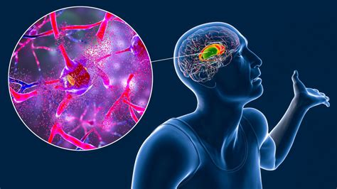 Huntington Disease at Bernardo Kuebler blog