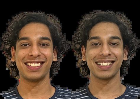 Invisalign® Clear Aligners in India – Cost, Process & Benefits | Clove ...