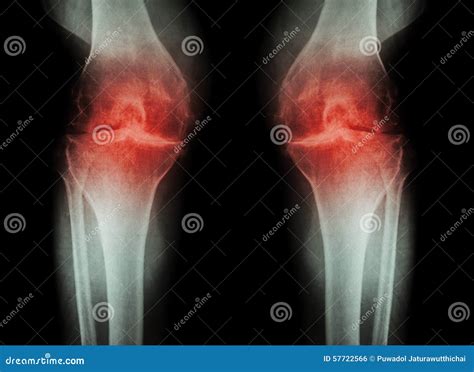 Rodilla De La Osteoartritis (rodilla) Del OA (radiografía De La ...