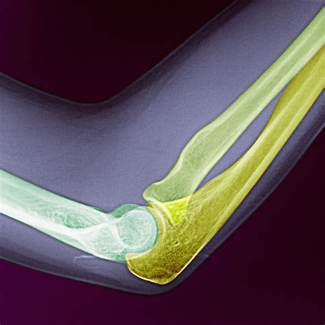 Ulna Hairline Fracture