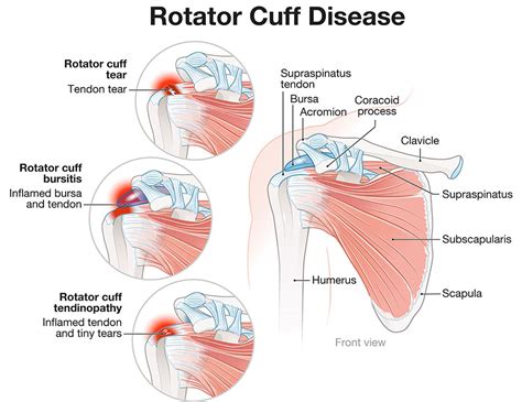 Image result for Left Rotator Cuff
