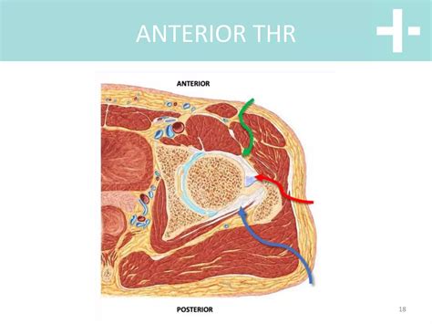 Hip anterior vs posterior total hip replacement | PPT