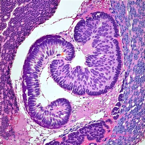 Breakthrough in Pancreatic Cancer: New Blood Test for Early Detection, Could Offer Improved Therapy