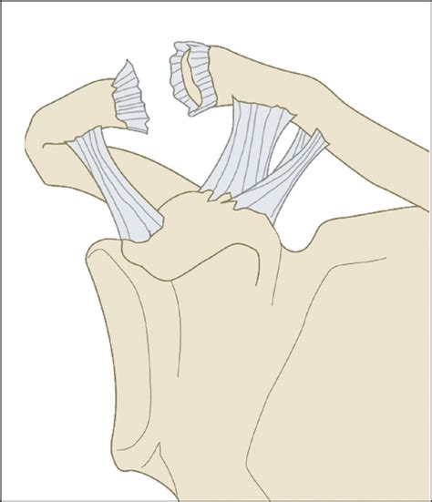 Image result for AC Step Defect