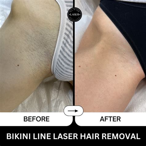 Laser Removal Hair Bikini