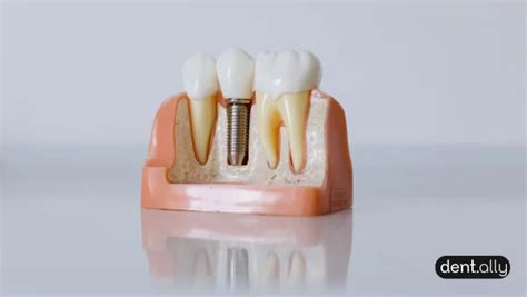 Can You Get a Dental Implant Years After Losing a Tooth? The Complete Guide