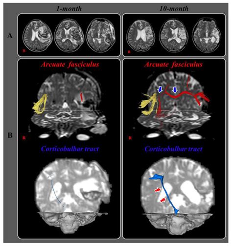 Diffusion Tensor Tractography Studies on Recovery Mechanisms of Aphasia ...