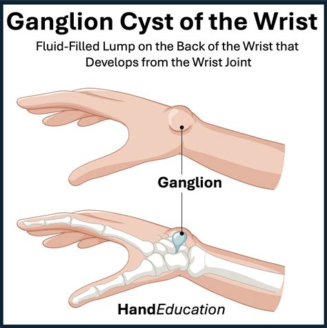 Ganglion Cysts of the Wrist - Hand Education