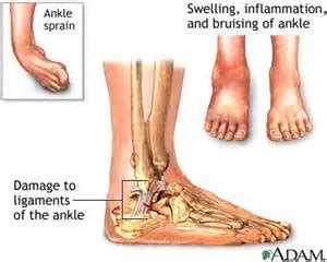 HOW LONG DOES A SPRAINED ANKLE TAKE TO HEAL 2 - Muscle Pull | Muscle Pull