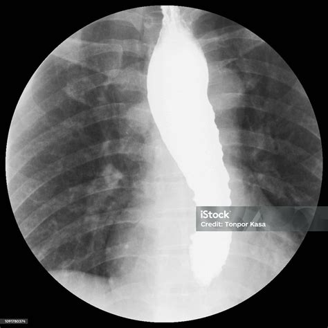 Barium Swallow Xray Evidence Of Achalasia At Distal Esophagus To Eg Junctionmoderate Proximal ...