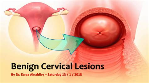 Benign Cervical Lesions | PPTX