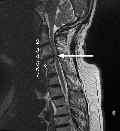 Orthopnoea and arm weakness | Thorax