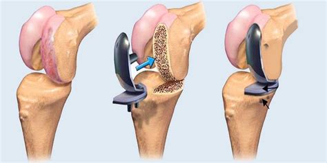 Exercises After Total Knee Replacement: Regaining Strength & Mobility