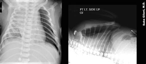 Image result for Sulcus Sign Lateral View