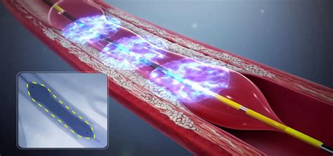 Anti-reflux Mucosectomy at Aster CMI Hospital