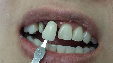 Case 1 – Porcelain Crowns | Ivory Dental