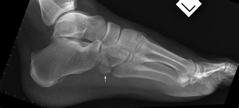 Nutcracker Fracture of the Cuboid - wikiRadiography