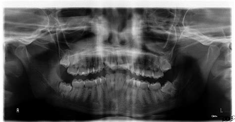 Tooth Abscess Xray