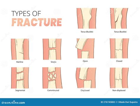 Types of Bones Fractures, Bones Fracture Classification Stock Vector ...