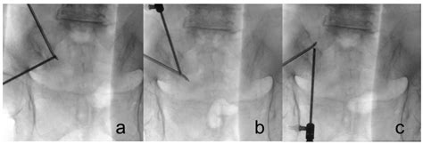 Biportal Endoscopic Radiofrequency Ablation of the Sacroiliac Joint ...