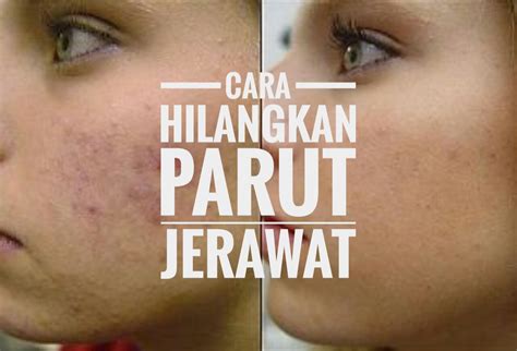 cara nak hilangkan jerawat batu