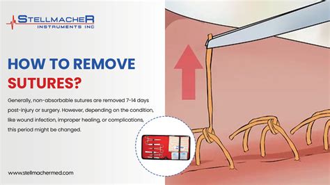 Removing Sutures Step by Step 的图像结果