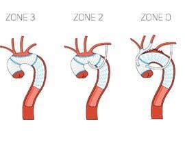 Educational Surgical Technique Illustration FET in Zone 3 2 and 0 ...