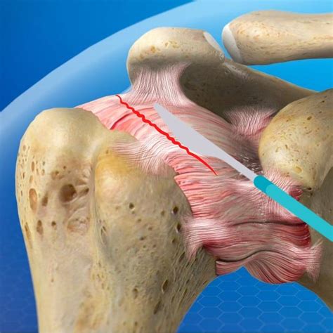 Surgery For Adhesive Capsulitis Shoulder