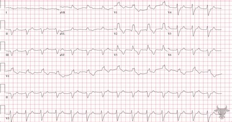 Left Anterior Fascicular Block | ECG Stampede