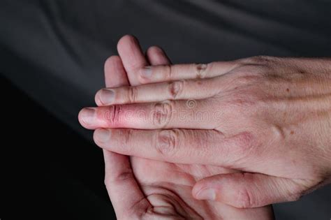 Splint Removal 的图像结果