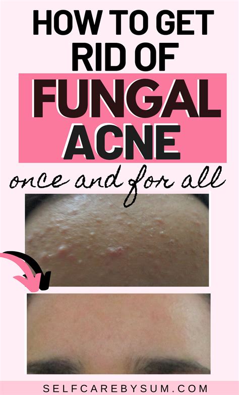 How to tell if you have fungal acne – Artofit