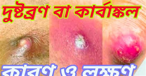 How to use Carbuncles: বিবরণ, কারণ, লক্ষণ ও চিকিৎসা