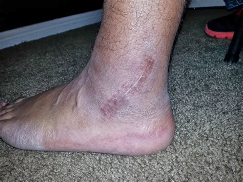 Peroneal Tendon Surgery Recovery: Ankle Time Line (updated for week 10/11)
