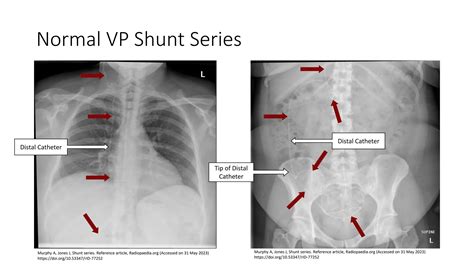 Implanted Devices - VP Shunts: EMGuidewire's Radiology Reading Room | PPTX