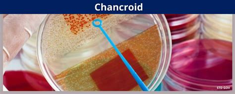 Chancroid - Benton Franklin Health District