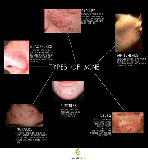 How to Recognize What Kind of Acne You Have | Innate Skin
