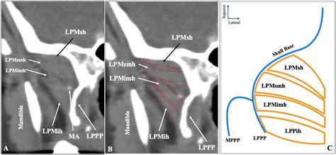 Morphological Spectrum of the Lateral Pterygoid Muscle: Radioanatomical ...