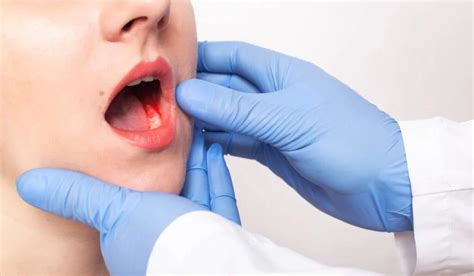 Oral cavity tumor symptoms | Mouth cancer treatment | Oral cavity tumor ...