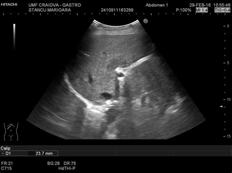 Fatty Liver Ultrasound