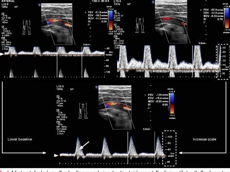 Cpt Code For Venous Doppler Lower Extremity at Kurt Scott blog