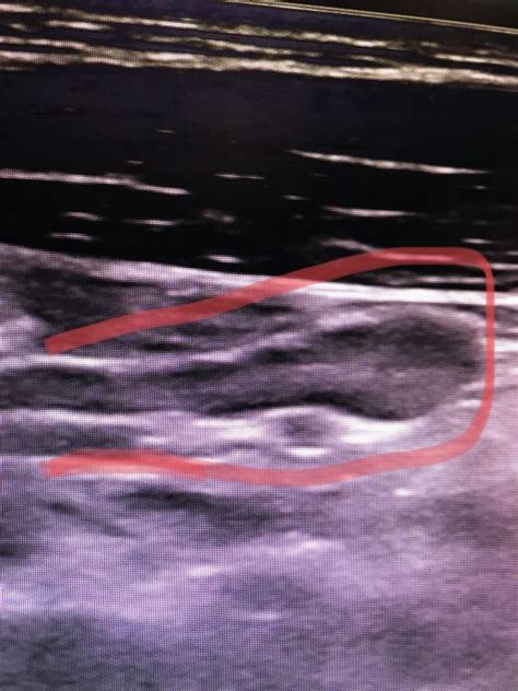 Image result for Normal Appendix Real