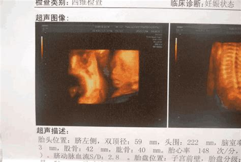 怀孕11周，明明孕吐还很厉害，可是医生却说胎儿已经停育了