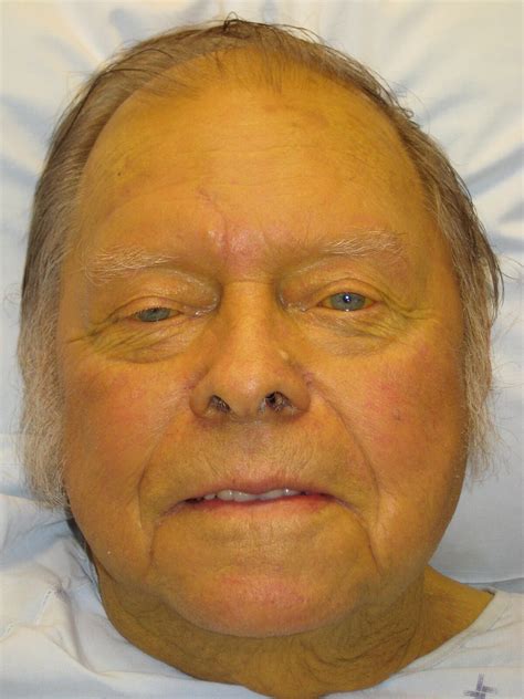 Jaundice - Wikipedia
