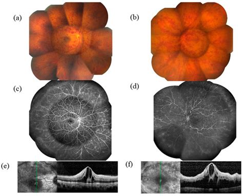 Cytokines and Pathogenesis of Central Retinal Vein Occlusion