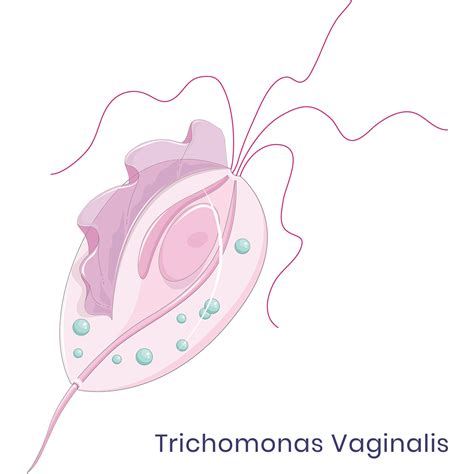 Trichomonas Vaginitis Novel Treatment Approaches To Combat
