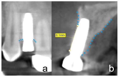 Retrospective Study on Tooth Shell Technique Using Endodontically ...